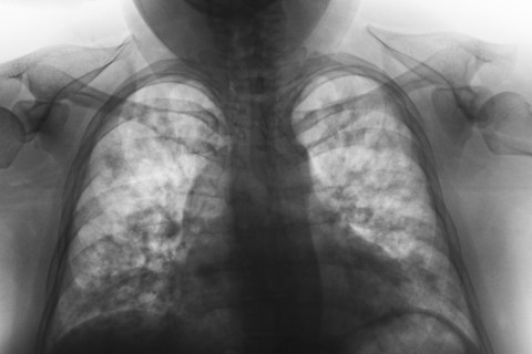 Abnormal chest xray, showing signs of a diseased lung