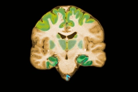 Alzheimer's brain scan