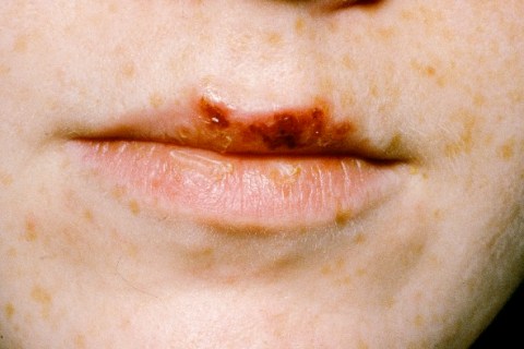 Herpes cold sores