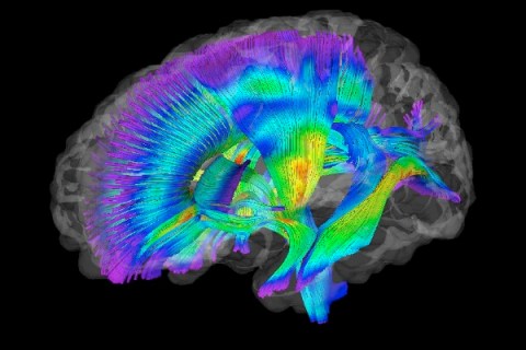 Brain scan of 6 month old who developed autism