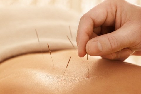 Acupuncture needles on woman's back