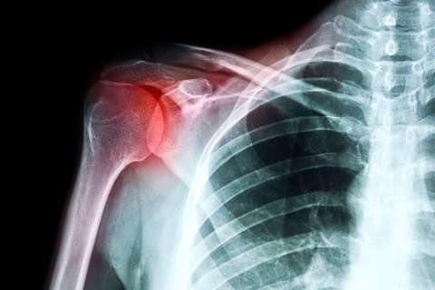 X ray of a shoulder in pain